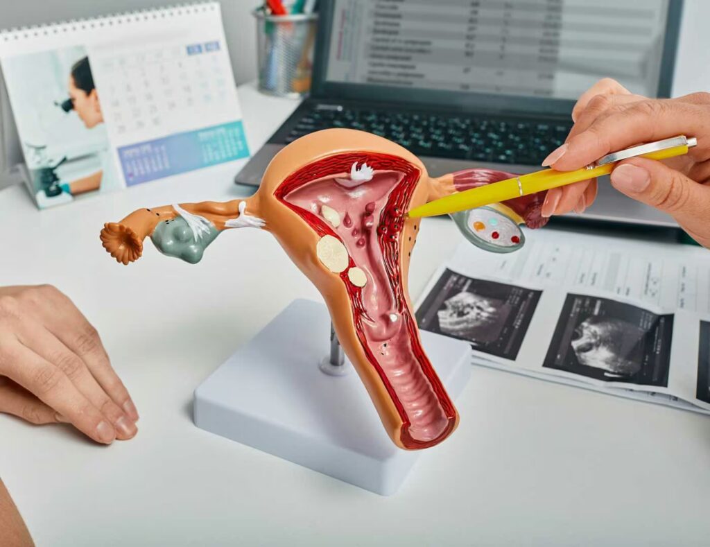 Female Pelvic Health 5 gynecologist showing polyps of endometrium of uter 2025 09 14 16 14 32 utc