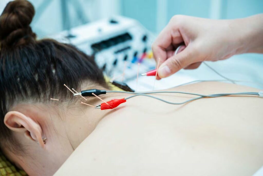 close up of electroacupuncture therapy on a patien 2025 09 08 16 18 48 utc