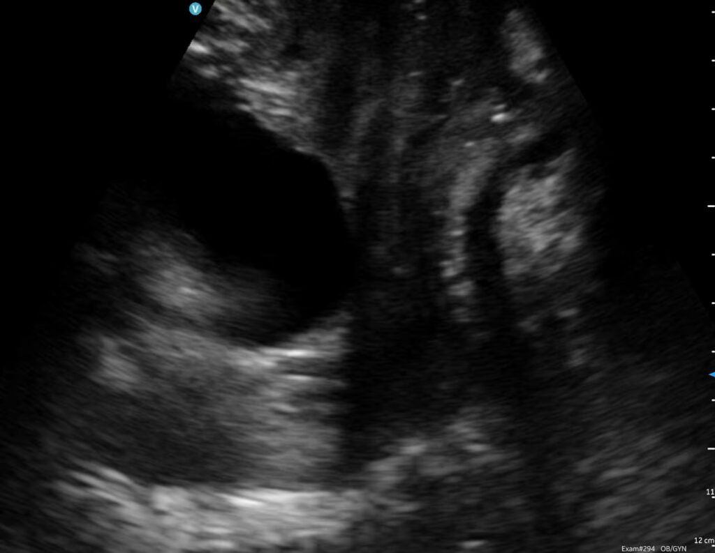 Ultrasoundpelvicfloor