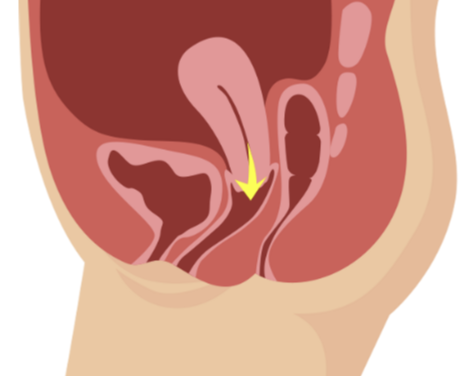 Female Pelvic Health Positive Week 1 ….From Pavement to Pelvis: Prolapse and the Runner’s Body Regain Your Run Strong 4 a7e32c5 1577 1613 3f67 5c5e1b74fe8 Screenshot 2025 08 06 091820